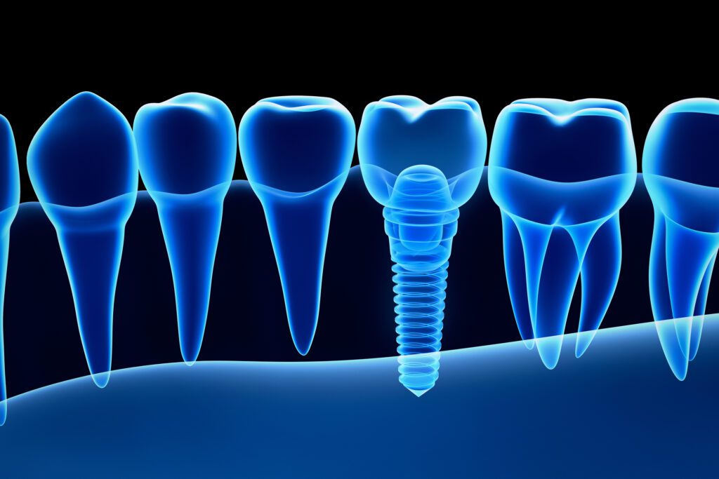 frequently asked questions about dental implants in Argyle, TX