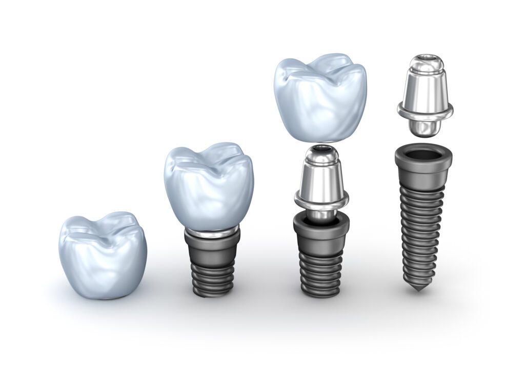 The benefits of dental implants in Argyle, Texas