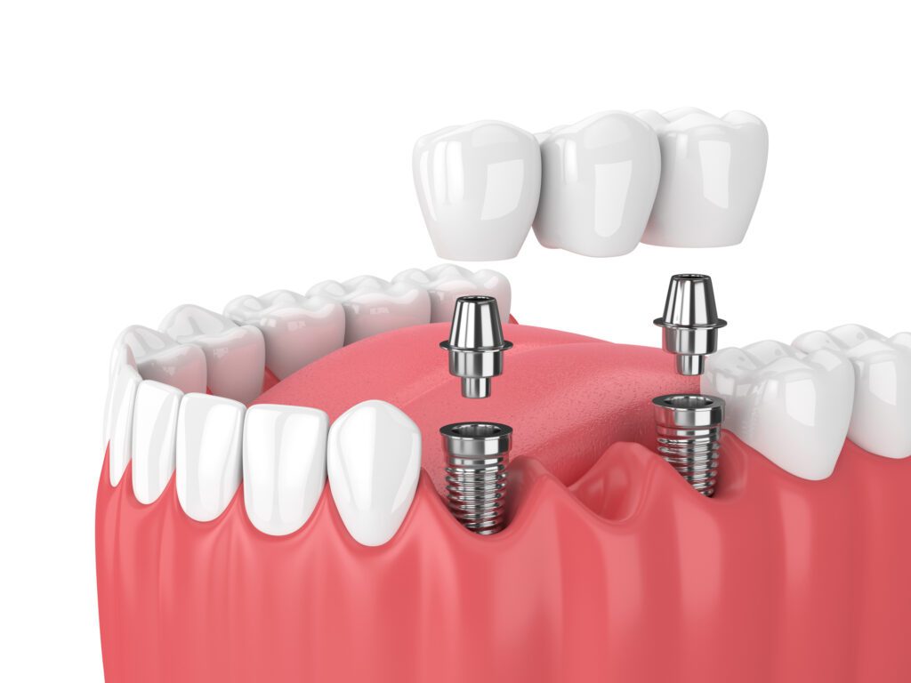 multiple dental implants in Argyle, TX